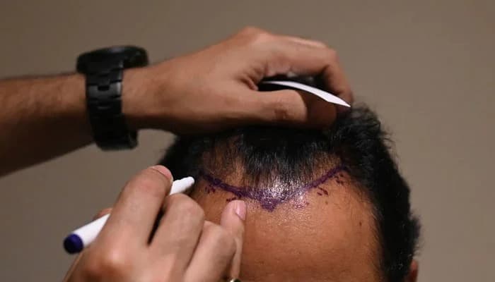 Hair Transplant Istanbul: 2025 Trends in Hair Restoration