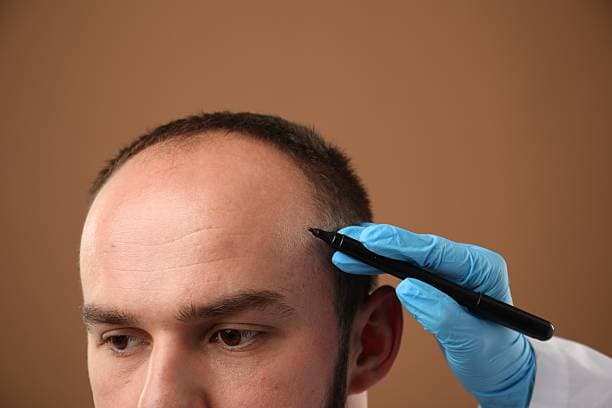 How Much Does Hair Transplant Cost Around the World?